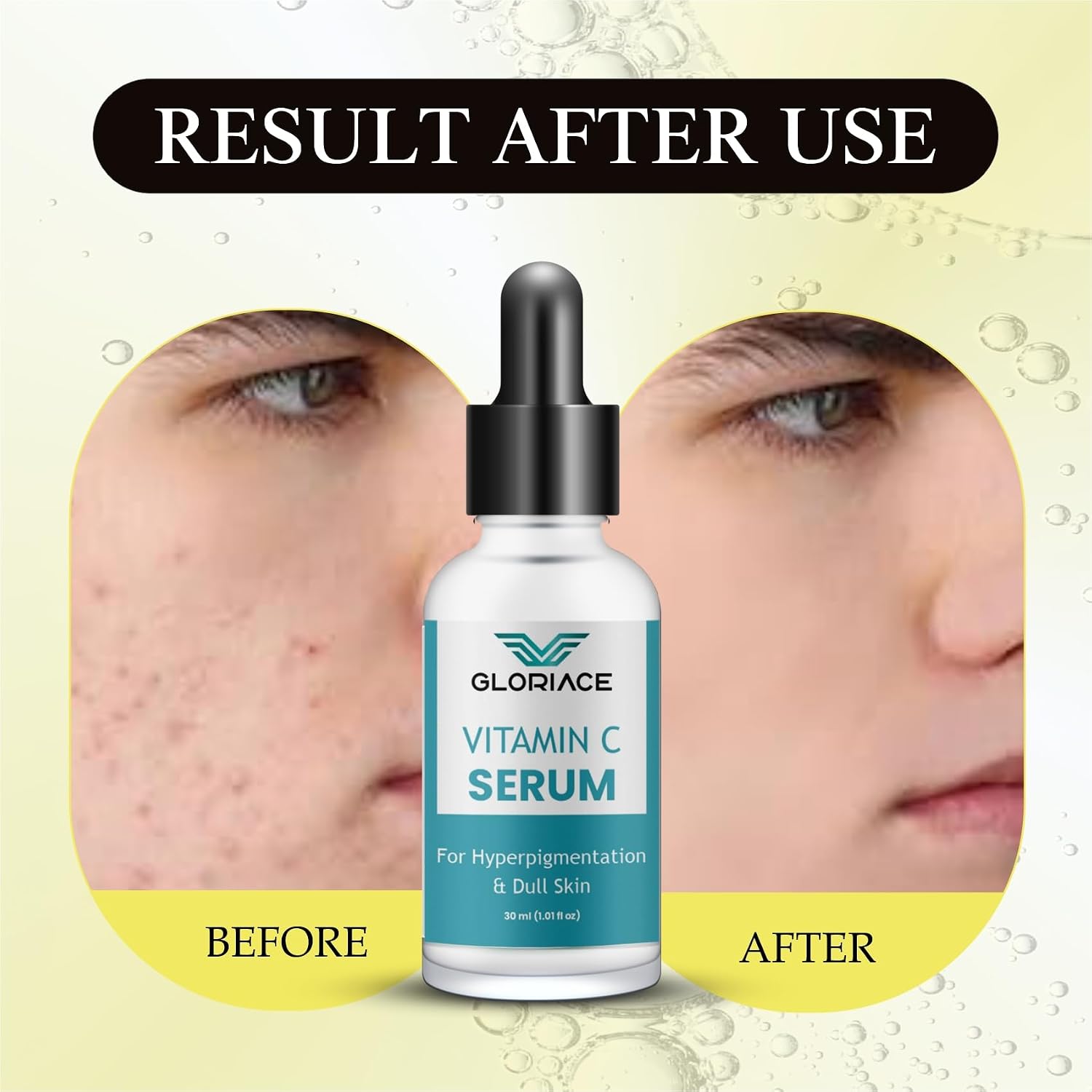 Gloriace Vitamin C Face Serum for Hyperpigmentation & Dull Skin, | Skin Brightening Face Serum, With Antioxidants for Glowing Skin, Fades Dark Spots & Uneven Tone 30 ml