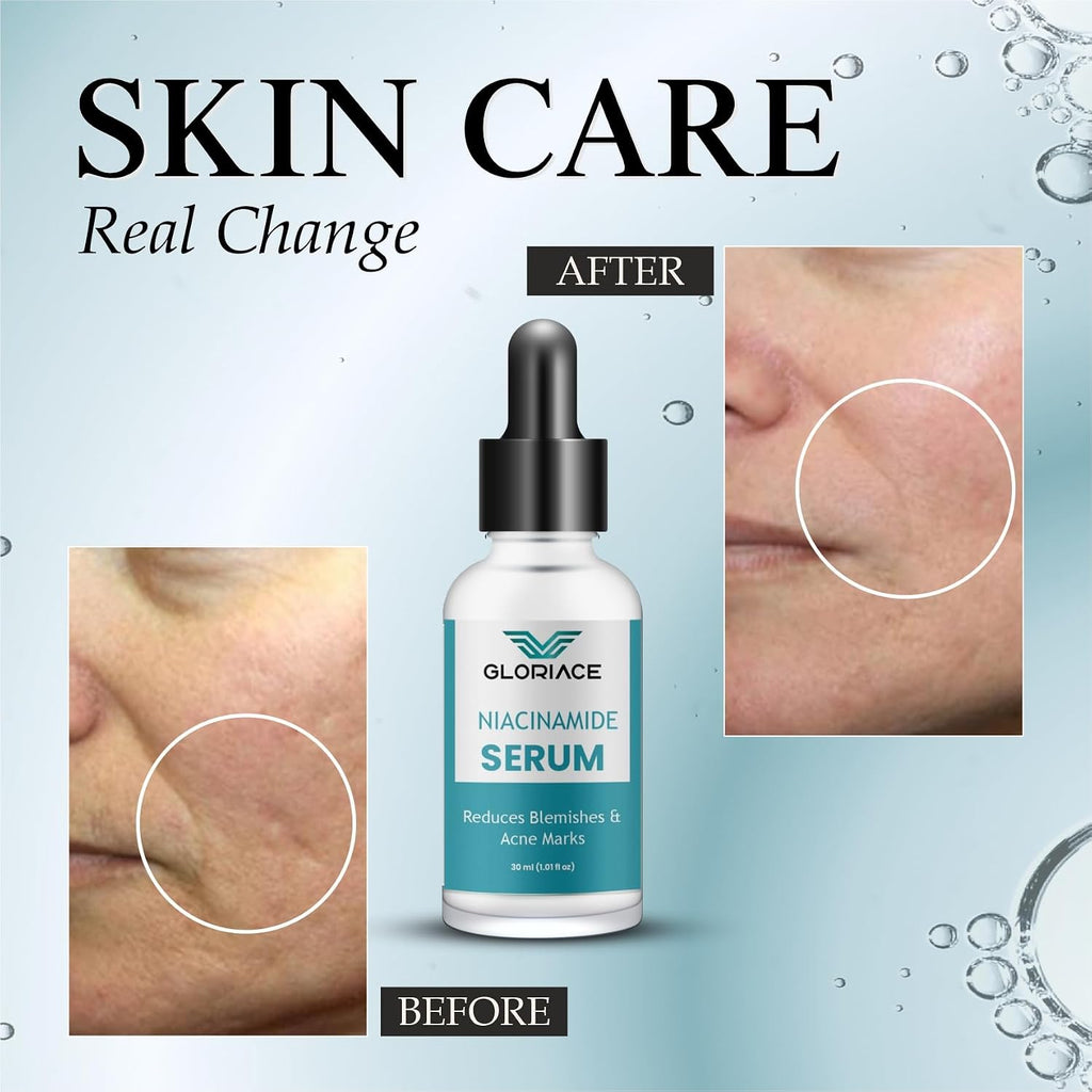 Gloriace Niacinamide Face Serum for Acne Marks, Pimples & Oily Skin | With Zinc PCD for Acne-Prone Skin | Oil Control & Spot Reduction Face Serum (30ml)