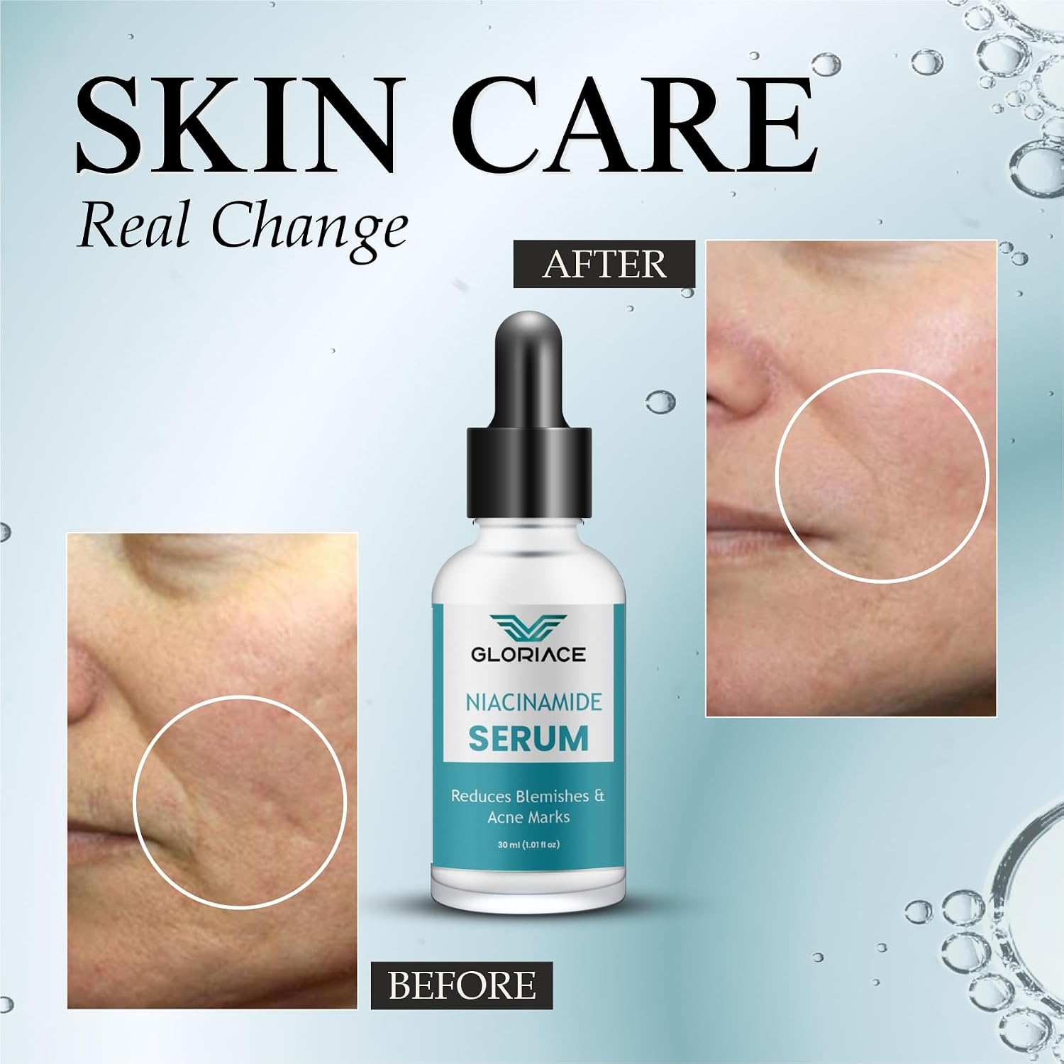 Gloriace Niacinamide Face Serum for Acne Marks, Pimples & Oily Skin | With Zinc PCD for Acne-Prone Skin | Oil Control & Spot Reduction Face Serum (30ml)